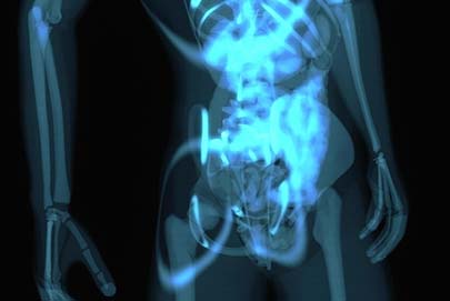 Bel Fıtığı neden olur?